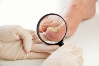 Who is Likely to Get Toenail Fungus?