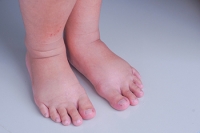 Causes of Puffy and Swollen Feet