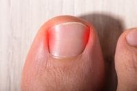 Ingrown Toenails and Their Causes